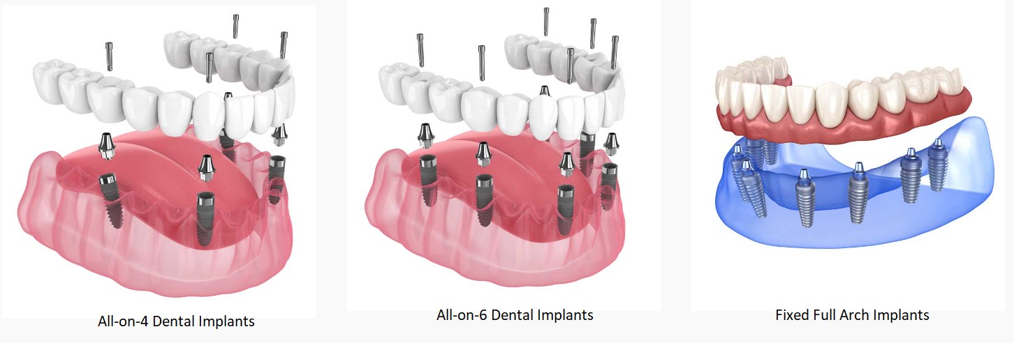 All-on-4, All-on-6 ve sabit tam çene implant protez seçeneklerinin çizimi
