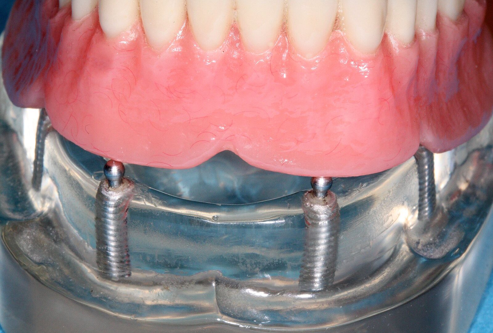 Dört implant üzerinde sabit tam çene protez modeli, Türkiye'de All-on-4 implant tedavisi