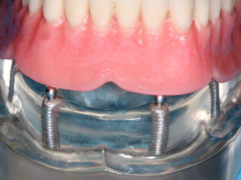 Dört implant üzerinde sabit tam çene protez modeli, Türkiye'de All-on-4 implant tedavisi