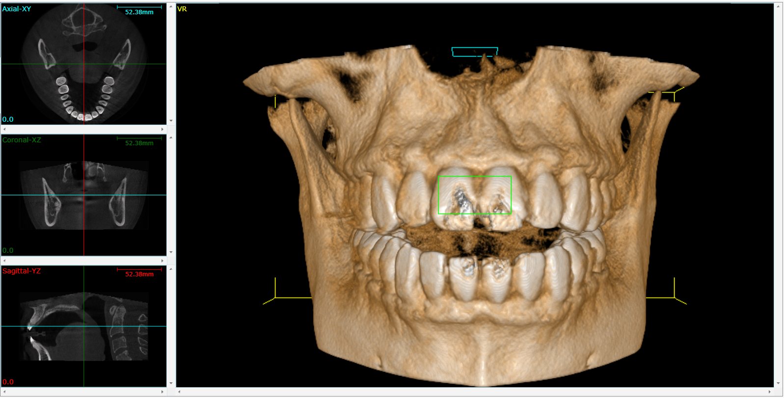 All-on-4 planlaması için konik ışınlı dental tomografi kesitleri ve 3 boyutlu çene görüntüsü