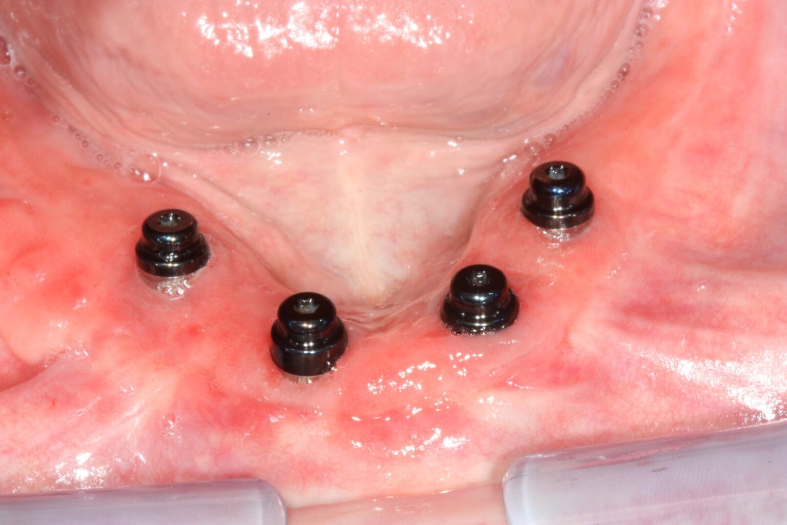Alt çeneye yerleştirilmiş dört implant ve bağlantı başlıkları, All-on-4 implant