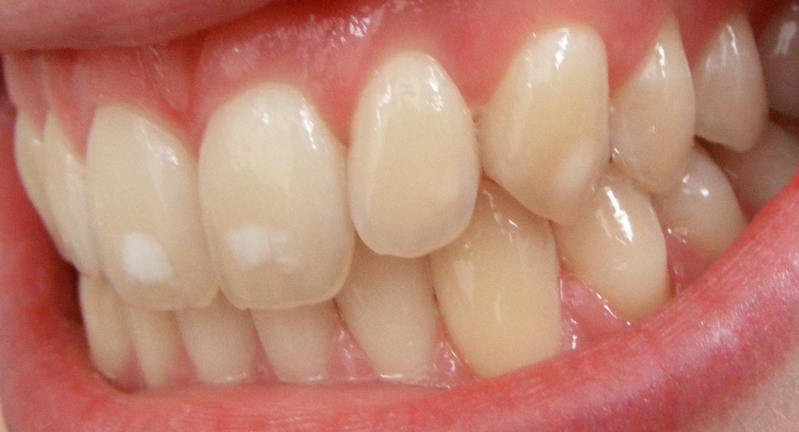 Personne souriant avec des dents d'une blancheur naturelle après un blanchiment dentaire