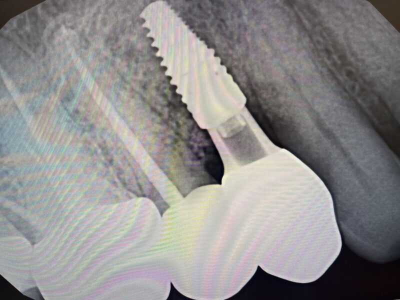Çene kemiğine yerleştirilmiş diş implantının röntgen görüntüsü
