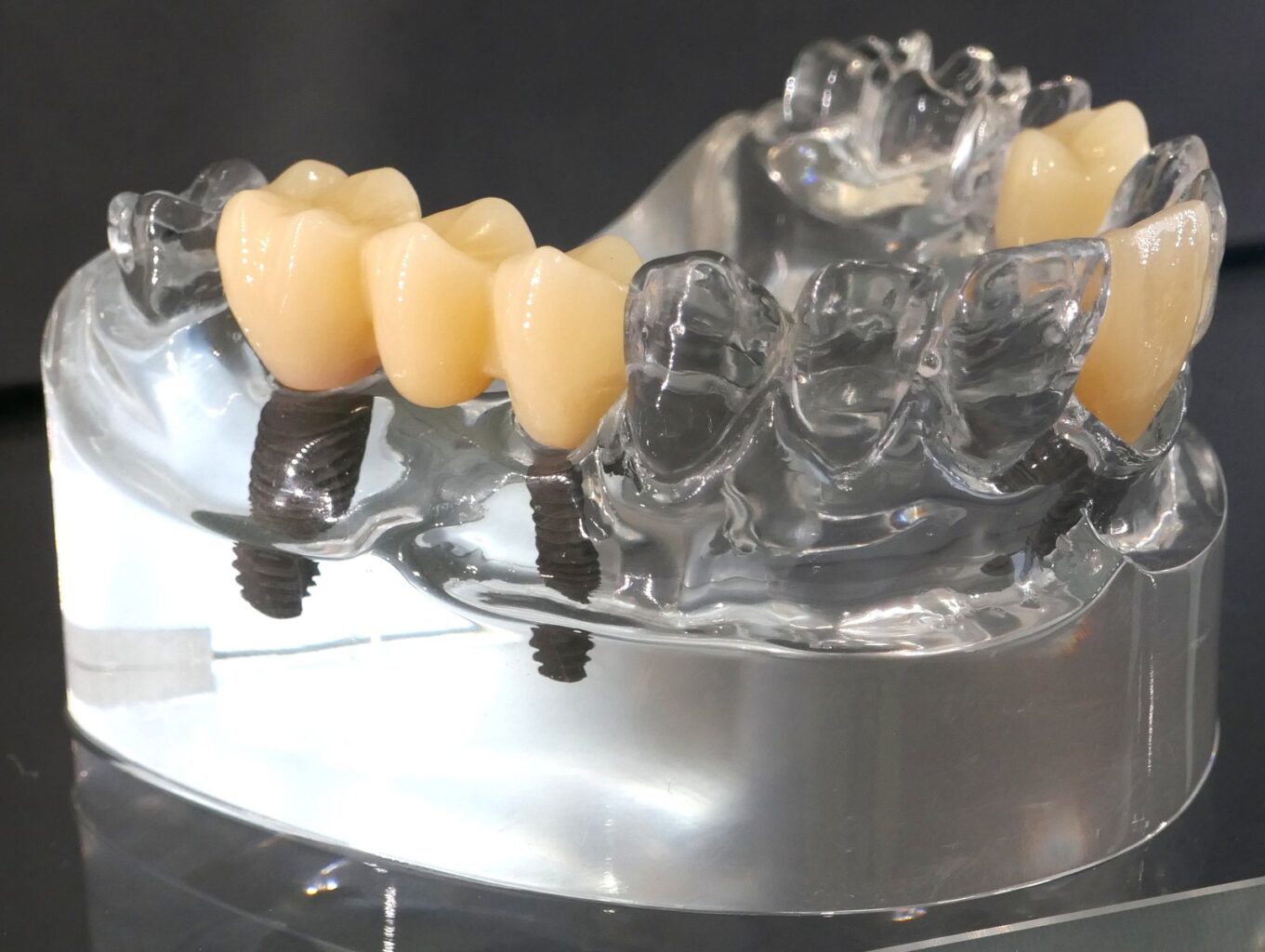 Şeffaf çene modelinde diş implantları ve implant üstü köprü