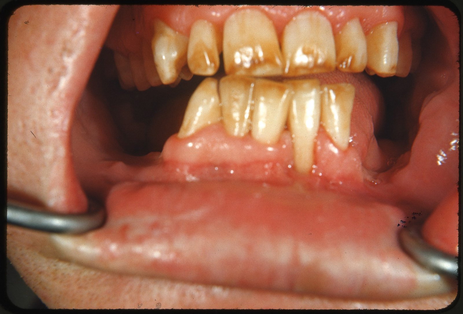 Jaunissement structurel et taches brunes sur les dents (exemple de fluorose)