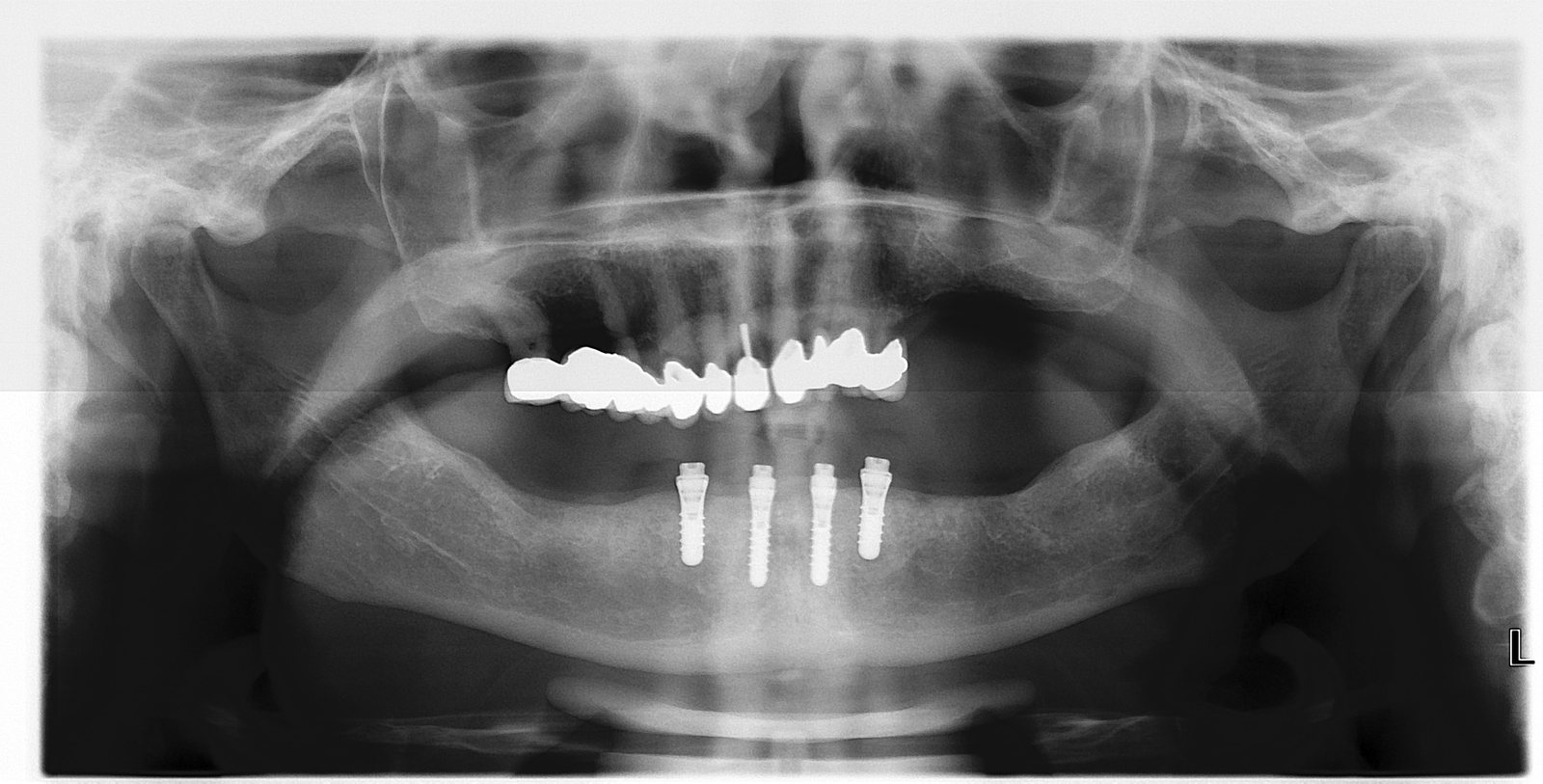 Tam çene implant üstü protez ve dört implant görünen panoramik diş röntgeni