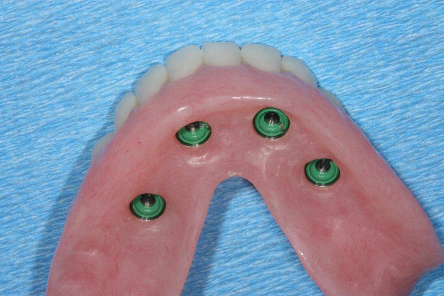 Alt çene için implant üstü hareketli protez, bağlantı parçaları görünüyor