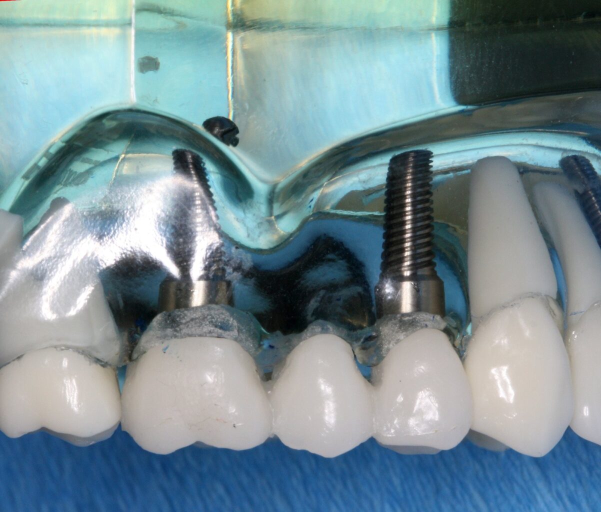 Şeffaf çene modelinde implant üstü sabit köprü ve implant vidaları