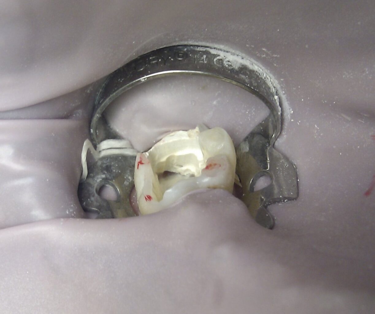 Tedavi sırasında metal kroşe ve lastik örtüyle izole edilmiş arka diş