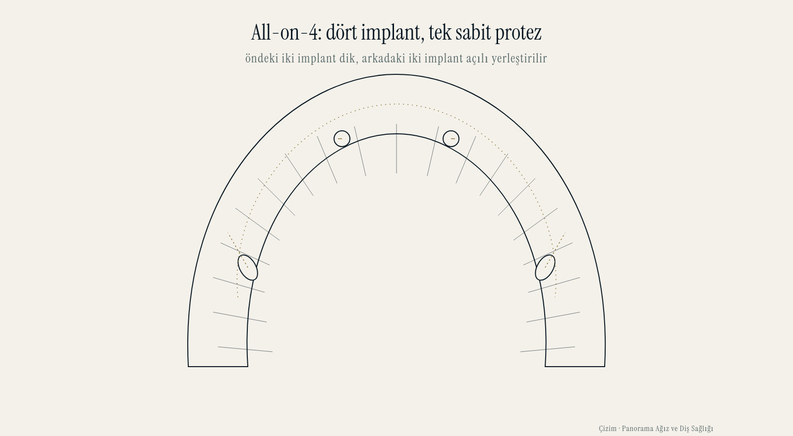 All-on-4 placement on a jaw arch seen from above: the two front implants upright, the two back implants angled