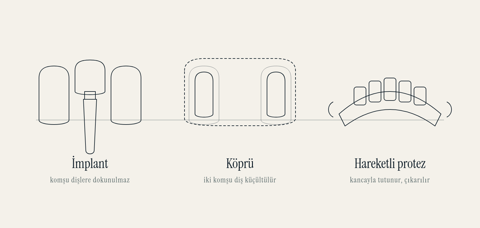 Drawing of the three options for a missing tooth: implant, bridge and removable denture
